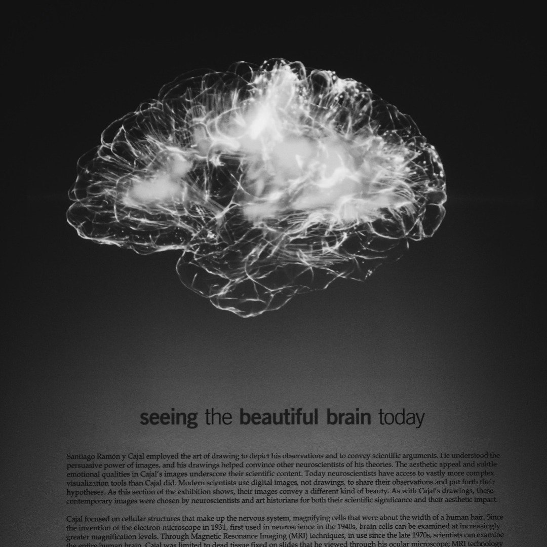Thought Defusion in OCD Treatment